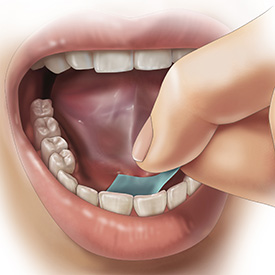 A PharmFilm® medication being applied under the tongue (sublingual delivery)